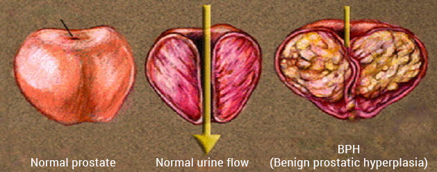 Benign Prostatic Hyperplasia Benign Prostatic Hyperplasia