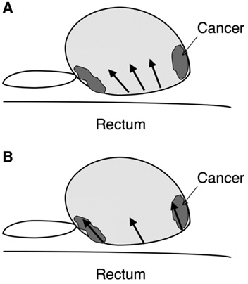 Extended biopsy (10-12 core biopsy)