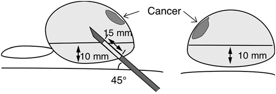 Extended biopsy (10-12 core biopsy)
