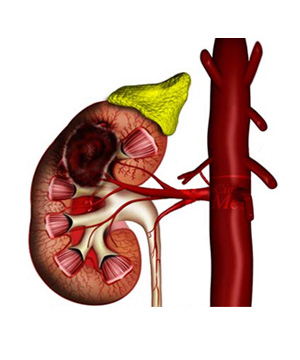 Kidney parenchymal cancer Kidney parenchymal cancer