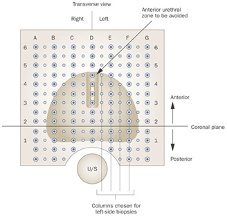 Saturation-Biopsy