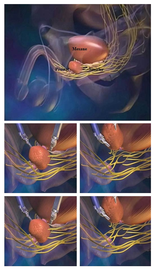 Stages of Robotic Radical Prostatectomy Operation Stages of Robotic Radical Prostatectomy Operation