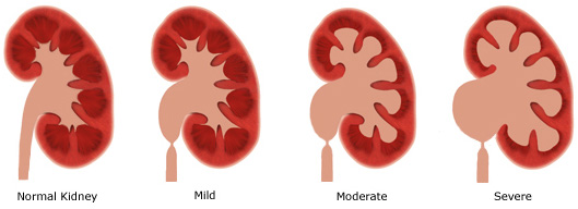 Ureteropelvic Junction Obstruction Ureteropelvic Junction Obstruction