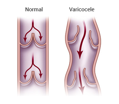 Reflux (backflow) to the vein Reflux (backflow) to the vein