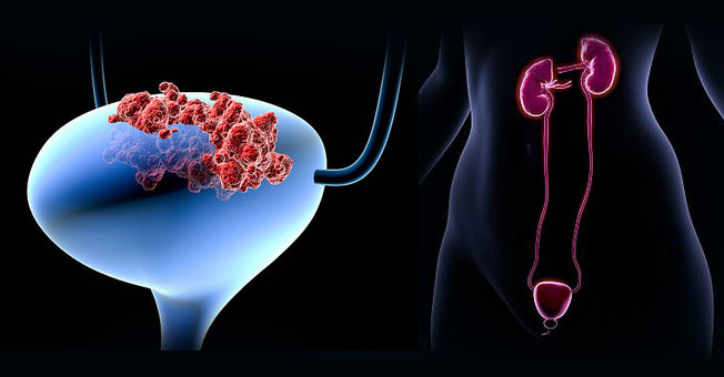 Bladder Tumors