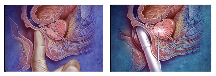 Prostate Biopsy