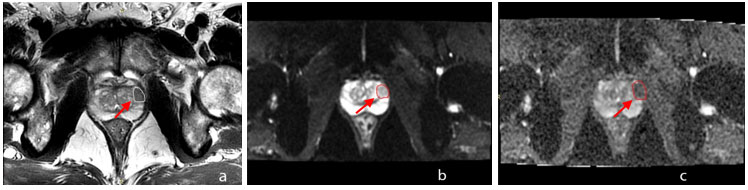 Multiparametrik prostat MRI (mp-MRI) Görüntüsü
