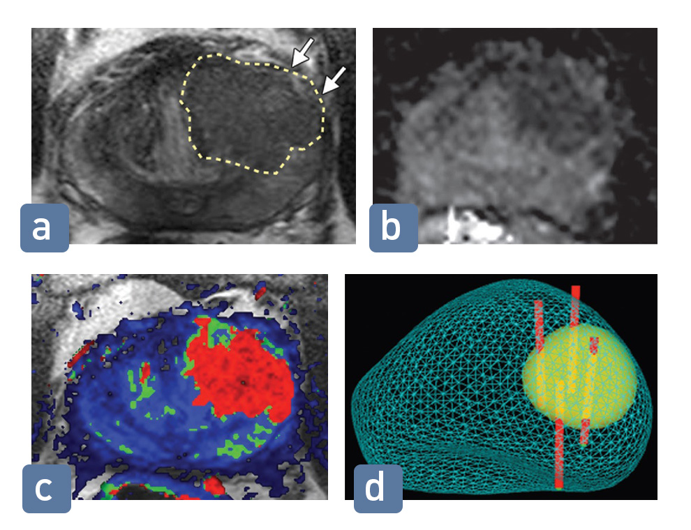 Prostat kanserinin Multiparametrik MR görüntüsü ve Füzyon biyopsi işlemi