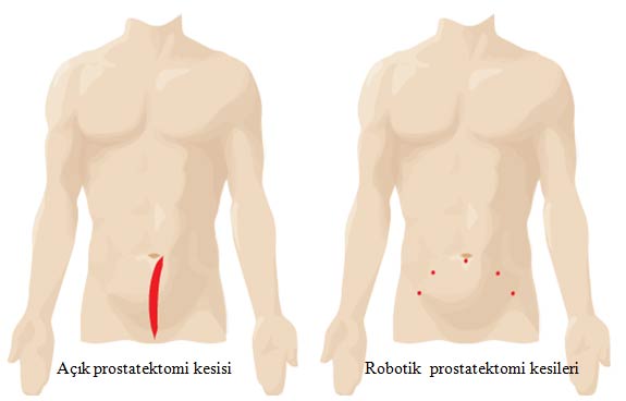 Robotik Cerrahi Farkı | Robotik Radikal Prostatektomi Kesikleri