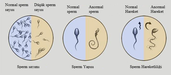Varikoselin testis ve sperm üzerine etkisi